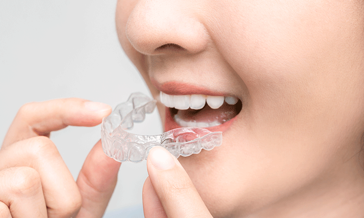 マウスピース矯正(インビザライン)
