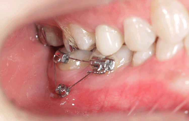 矯正用インプラント(ミニインプラント)