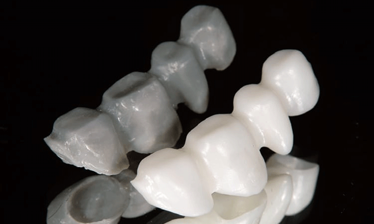 ジルコニアベース オールセラミッククラウン